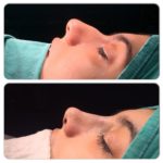 Nose Filling (Non-Surgical Nose Shaping)