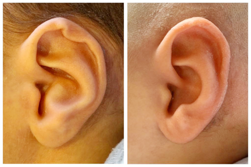 Kulak Estetiği Ameliyatı