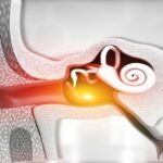 Orta Kulak Enfeksiyonu Tedavisi